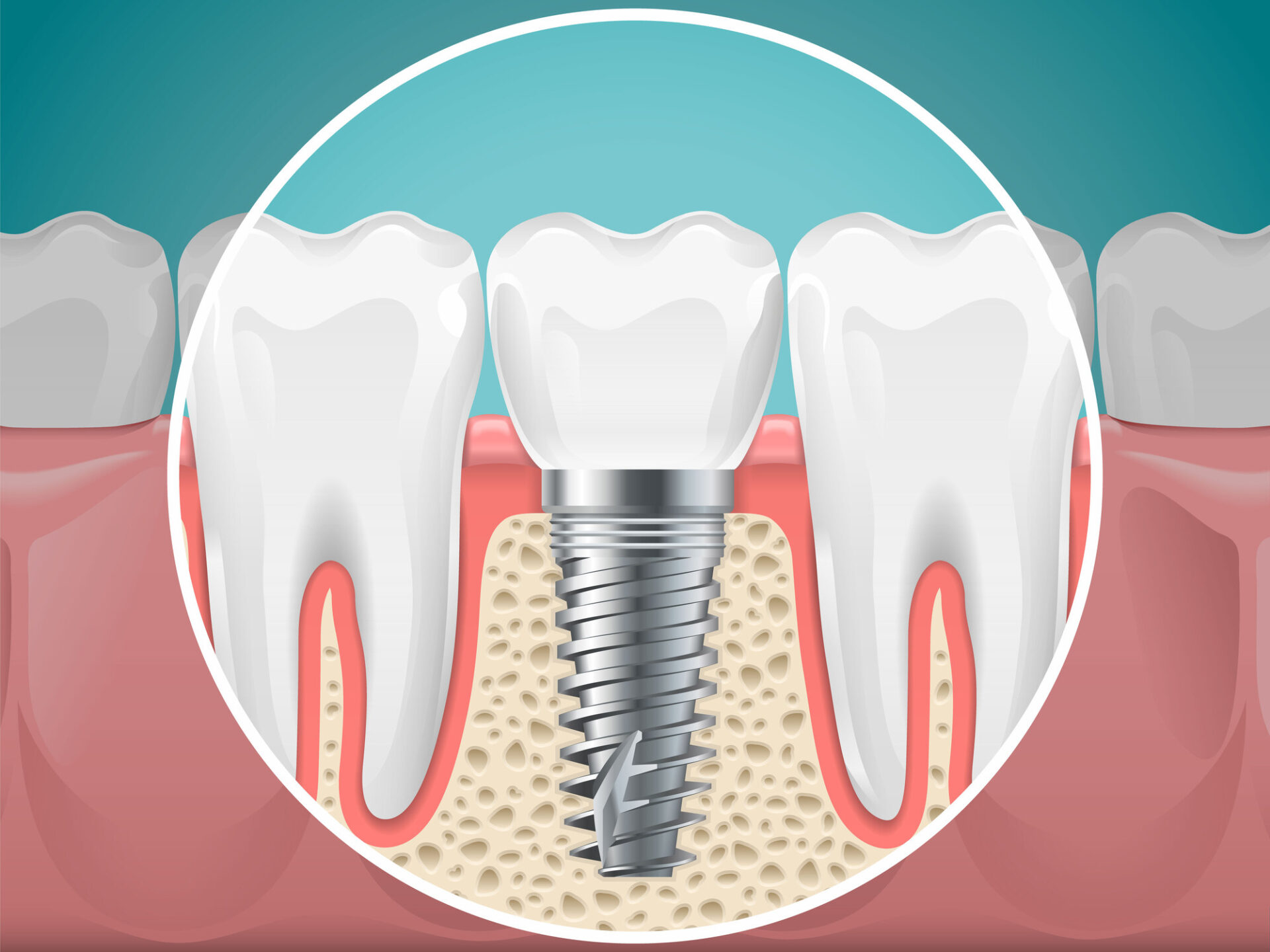 Stomatology illustrations. Dental implants and healthy teeth